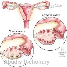 سندروم تخمدان پلی کیستیک